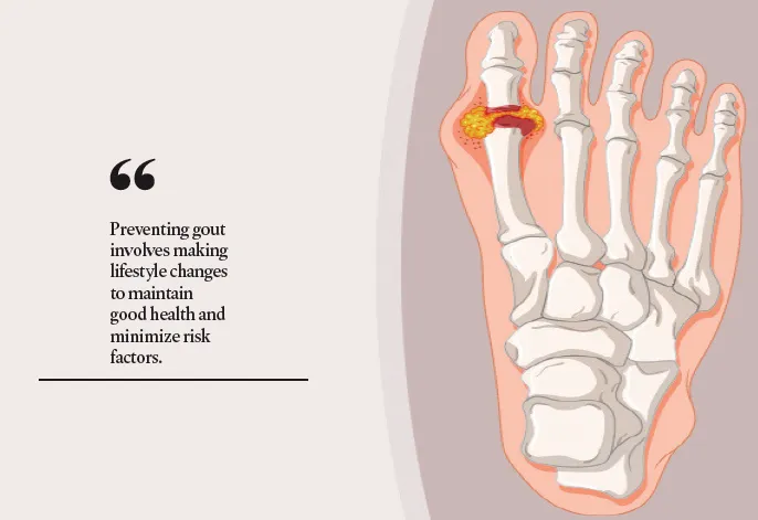 Understanding Gout: Causes, Symptoms and Management - Greater Kashmir