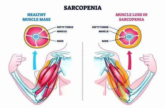 Sarcopenia: Age-Related Muscle Loss