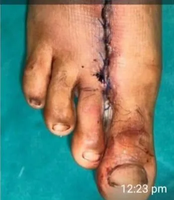 SKIMS performs microvascular toe to hand transplant surgery